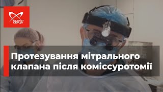 Протезування мітрального клапана після коміссуротомії 🔷  Інститут серця