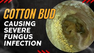 Cotton Bud Causing SEVERE Fungus Infection 😡