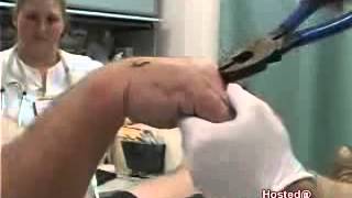 Huge Nail in Hand