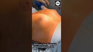 Gynecomastia (Puffy nipple) before and after results. Ture results with great transformation.