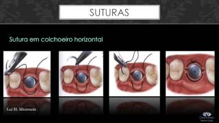 Tutorial de suturas odontológicas