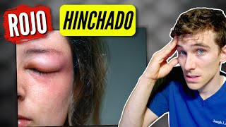 Párpado Hinchado? (Causas y Soluciones)