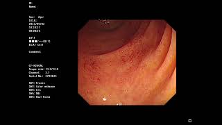 HEVC(H.265) image quality color. This is the actual color during endoscopy.