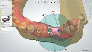 3shape model builder implant - Digital model design