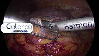 DR CALARCO - Kidney Cyst - Laparoscopic deroofing