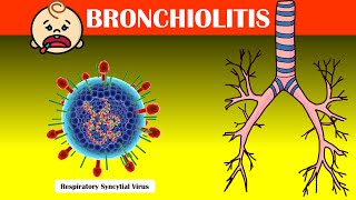 Understanding The Basics On Bronchiolitis - Causes, Signs & Symptoms, Diagnosis, Treatment