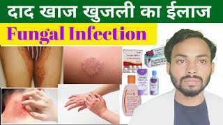 दाद खाज खुजली // फंगल इन्फेक्शन का पूरा इलाज//💯 Treatment Of Fungal Infection in Private Part/Hindi