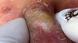 Big Cystic Acne Blackheads Extraction Blackheads & Milia, Whiteheads Removal Pimple Popping #PA219