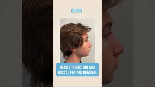 Neck liposuction and buccal fat pad removal🙌🏼✨