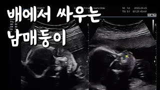 쌍둥이 21주 정밀 초음파 결과 과연?! (임신 중기 남매 둥이)