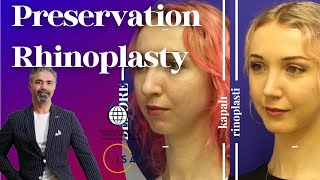 Preservation Rhinoplasty  | Let Down Rhinoplasty  | Push Down Rhinoplasty #preservationrhinoplasty