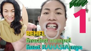 TUTORIAL Cara pasang behel bracket permanen part 1