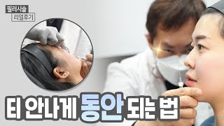 동안얼굴필러 리얼후기 + 꿀팁★/티안나게 동안만들어주는 예뻐진클리닉 필러장인의 시술