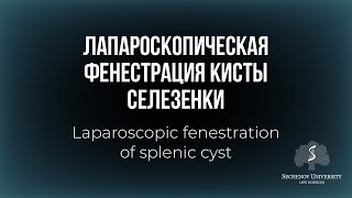 Лапароскопическая фенестрация кисты селезенки / Laparoscopic fenestration of splenic cyst