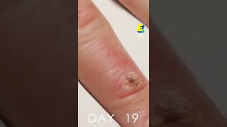 Healing of an injured finger