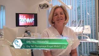 Diş Teli Öpüşmeye Engel Midir? | Diş Teli Tedavisi | Dr. estethica