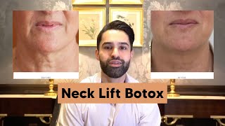 Neck Lift Botox