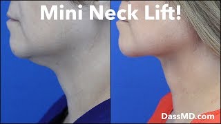 Mini Neck Lift Tightens Skin Fixes Double Chin - Beverly Hills Plastic Surgeon