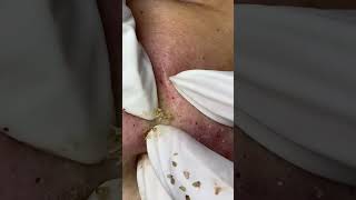 Big Cystic Acne Blackheads Extraction Blackheads & Milia, Whiteheads Removal Pimple Popping