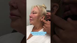 Deep plane facelift and a revision deep neck lift🌟