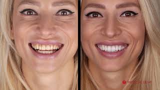 Smile Design - Veneer Placement by Dr Branimir Kirilov | Medical Dent