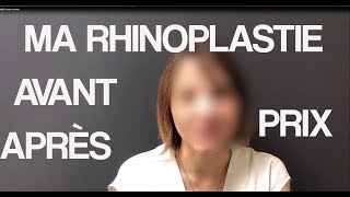 Ma Rhınoplastıe: Avant/Après/ Prix