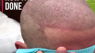 Scalp Micropigmentation by Antonio Baroque (still a little red)😐 it will go away​ in 24 hours