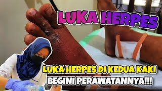 LUKA HERPES DI KEDUA KAKI ❗RIWAYAT DIABETES ❗BEGINI PERAWATANNYA