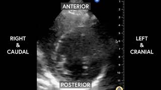 Normal Parasternal Short Axis