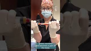 Learn more about transferring your own fat as filler into the face.  Atlanta's Beaty Facial Plastics