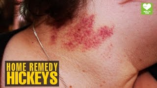 How To Treat Hickeys | Health Tips | Educational Video