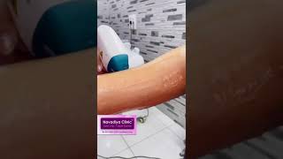 Best Laser Hair Removal & Skin Care, Laser Hair Removal, Navadiya Skin Care