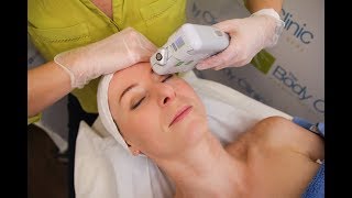 HIFU Non-Surgical Face Lift with the Doublo S