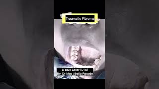 Traumatic Fibroma, Laser Treatment | Dr Mae Abella