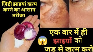 प्याज से झाइयां हटाने का कमाल का तरीका | Reduce Melasma, Pigmentation, 💞 Discolouration, Blackspots