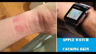 Apple Watch causing skin irritation for some users