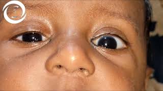 Ophthalmic Signs Eyelids