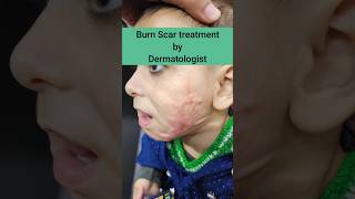 How dermatologist treat burn scar @DrArifMDDermatologist #Burn scar #keloid