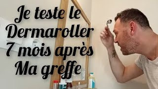 je teste le dermaroller 7 mois après ma greffe de cheveux, hair MD