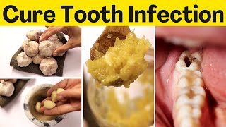 Get rid of tooth infection naturally fast quick without antibiotics root canal going to the dentist