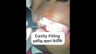 Cavity Filling  දත්වල කුහර පිරවීම Britanna Dental Clinic