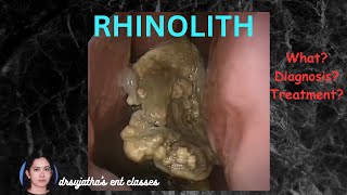 249.What is Rhinolith? Rhinolith #medicalstudent