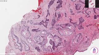 Ameloblastoma- Conventional/multicystic type