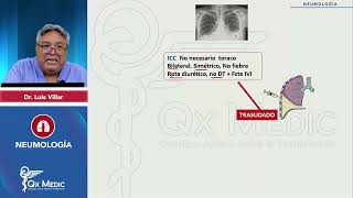 PI24   NEUMOLOGÍA   Patología de pleura  Trasudado