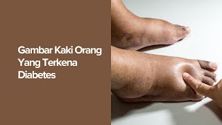 Gambar Kaki Orang Yang Terkena Diabetes