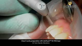 Class 5 cavity preparation with LiteTouch™ Er:YAG laser