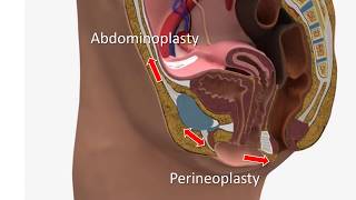 Vulvoplasty 2015