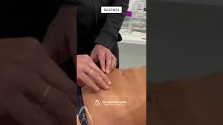 Dr. Alejandro Acuña | Vaser Lipo + Renuvion