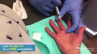 Trigger Finger Injection  - Reno Sparks MedSpa - Dr. Calvin Van Reken