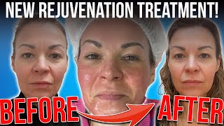 Exosomes Microneedling Facial Review + Before & After!